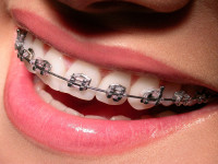 Установка брекетов