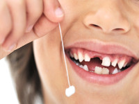 Простое удаление зубов