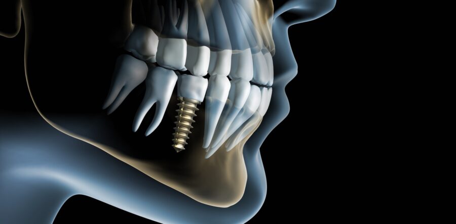 Имплантация зубов – это больно?