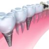 Имплантация зубов: современное решение проблемы с зубами