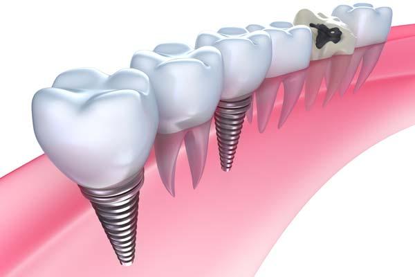 Имплантация зубов: современное решение проблемы с зубами