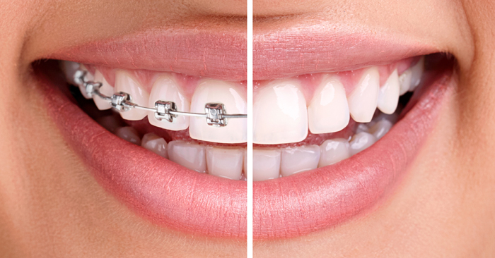 Исправление прикуса в раннем возрасте. Установка брекетов