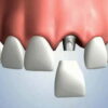 Десять причин в пользу имплантации зубов