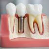 Новый метод протезирования зубов — имплантация