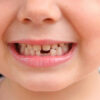 Стоматологию в Нур-Султане (Астане). Почему шатаются зубы?