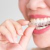 Исправляем неровные зубы: профессиональная стоматологическая помощь в Нур-Султане