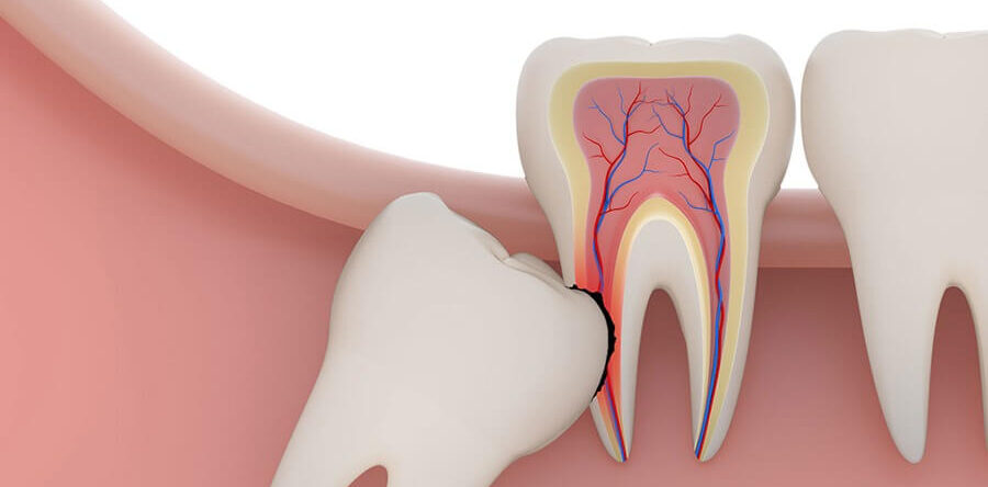 Стоит ли удалять зубы мудрости?