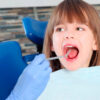 Лечение пульпита зуба у взрослых