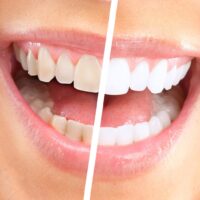 Как часто можно отбеливать зубы?