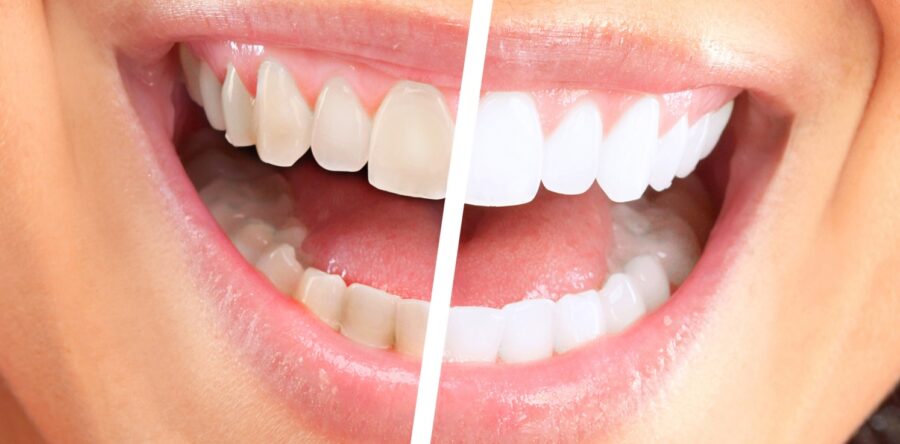 Как часто можно отбеливать зубы?