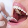 Чем опасен кариес на зубах и какие сопутствующие заболевания он вызывает