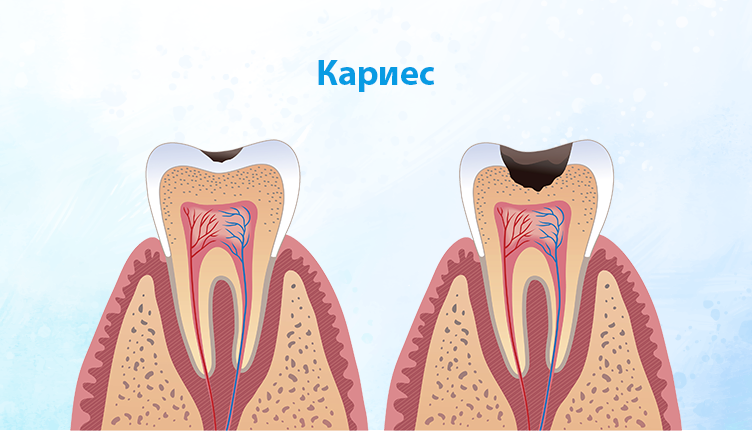 Лечим кариес молочных зубов