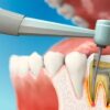 Почему болит зуб после пломбирования каналов