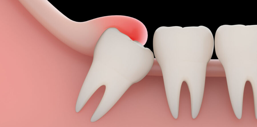 Когда нужно удалять зуб мудрости?