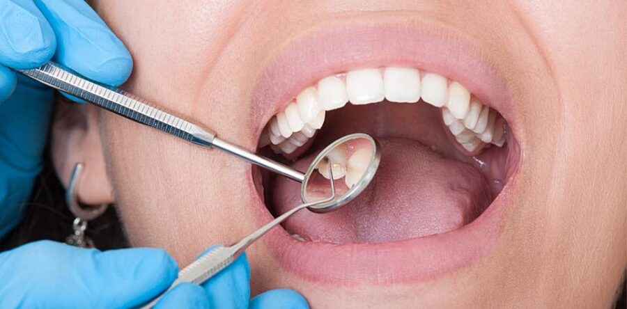 Как распознать начинающийся кариес у ребенка?