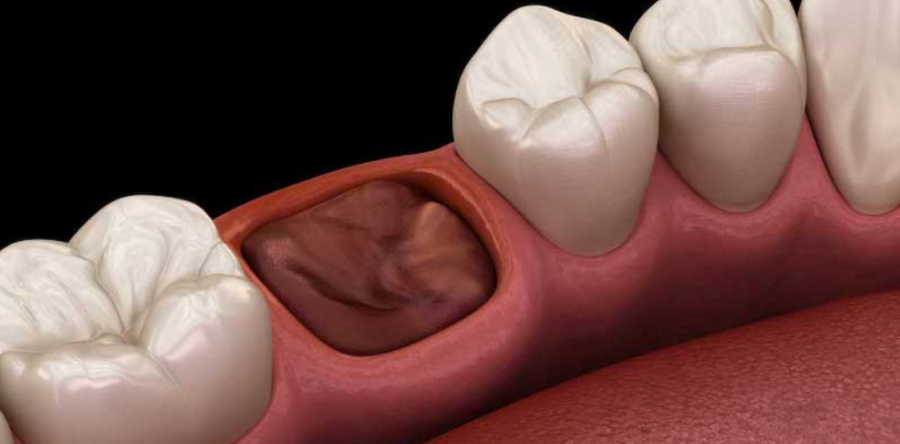 Что делать после удаления зуба с корнем: важные рекомендации